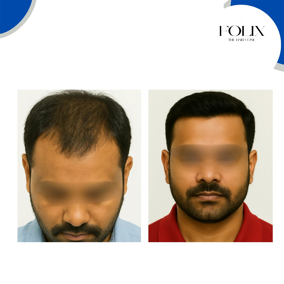 folix hair 1 copy 10