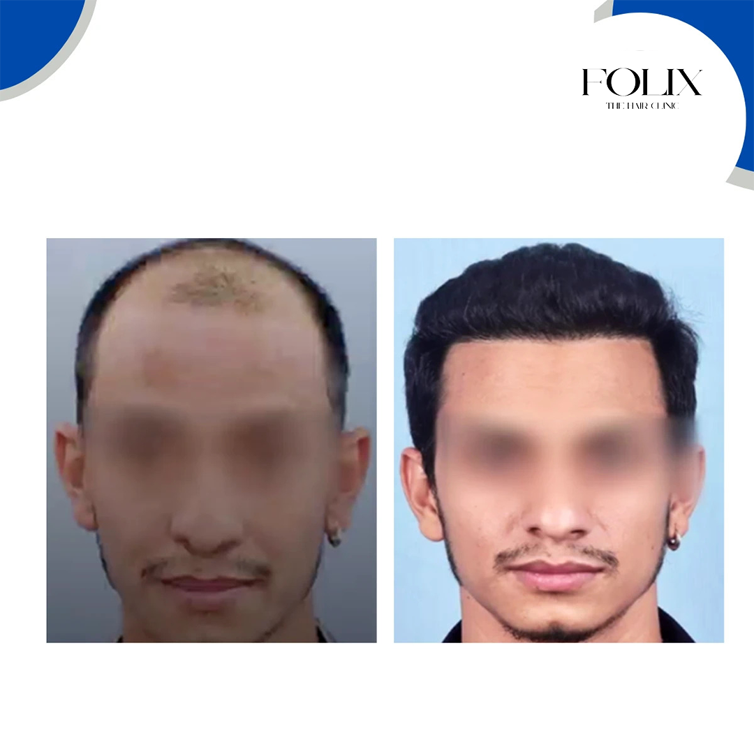folix hair 1 copy 12