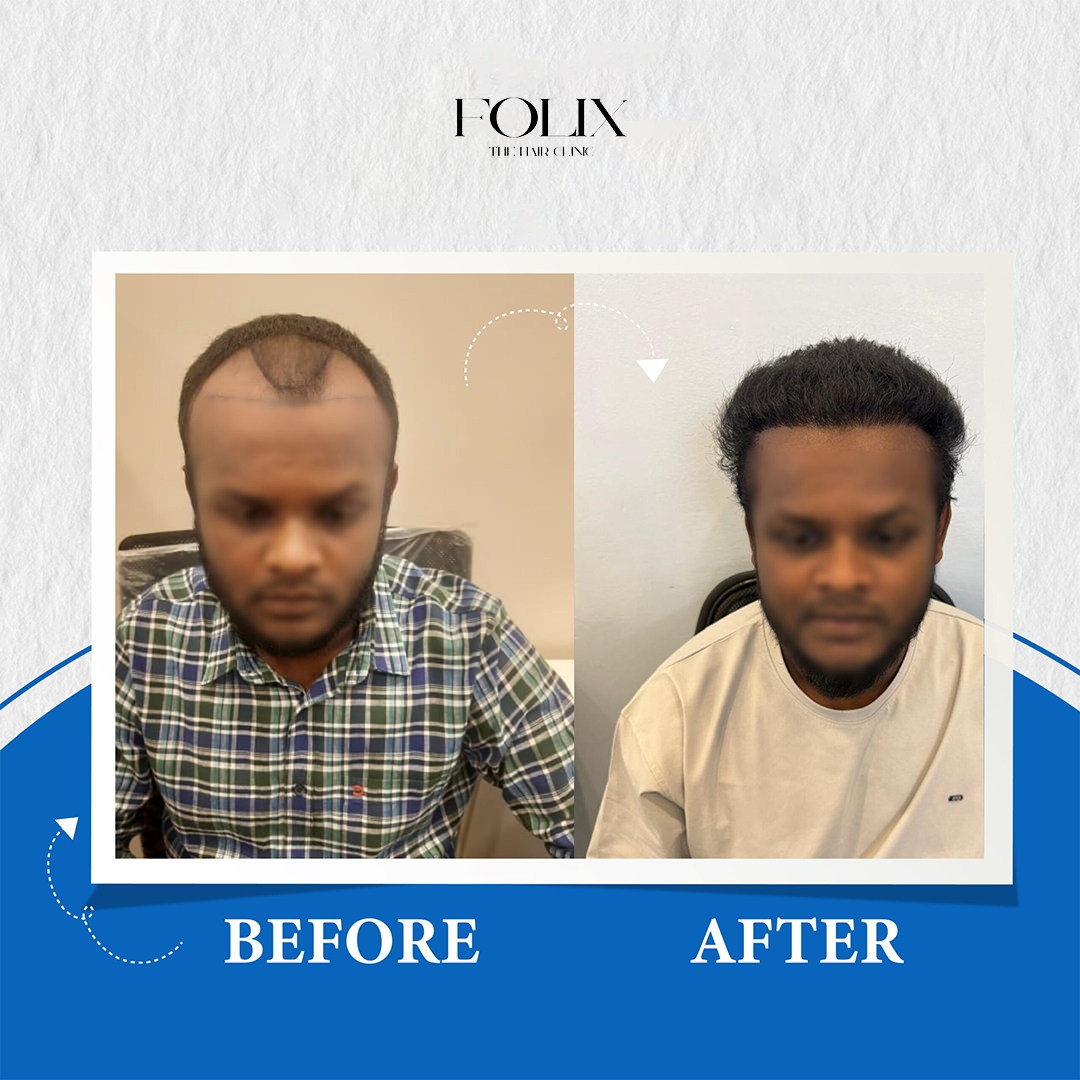 folix hair 1 copy 14