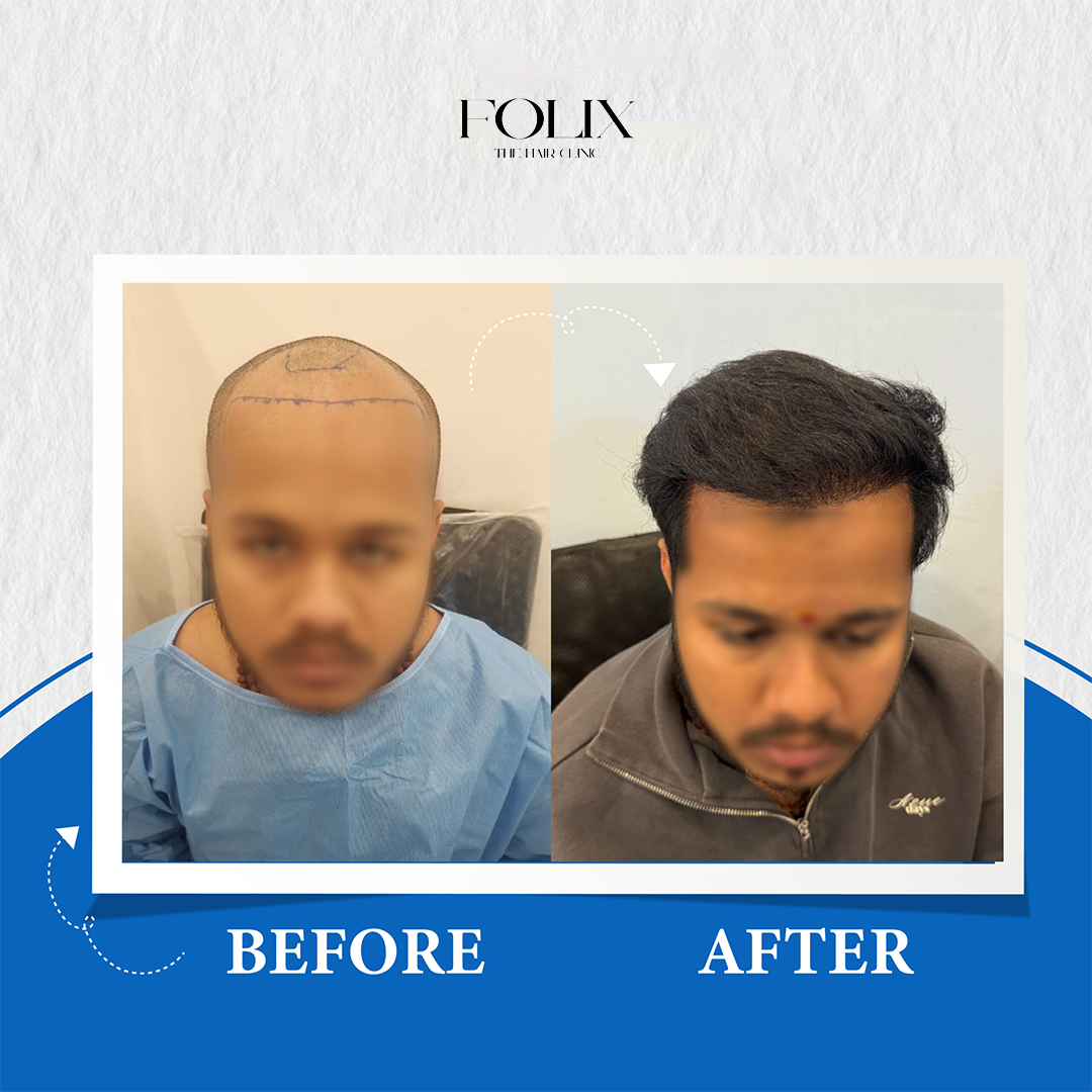 folix hair 1 copy 15