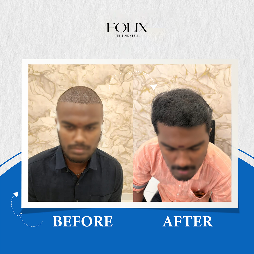 folix hair 1 copy 16