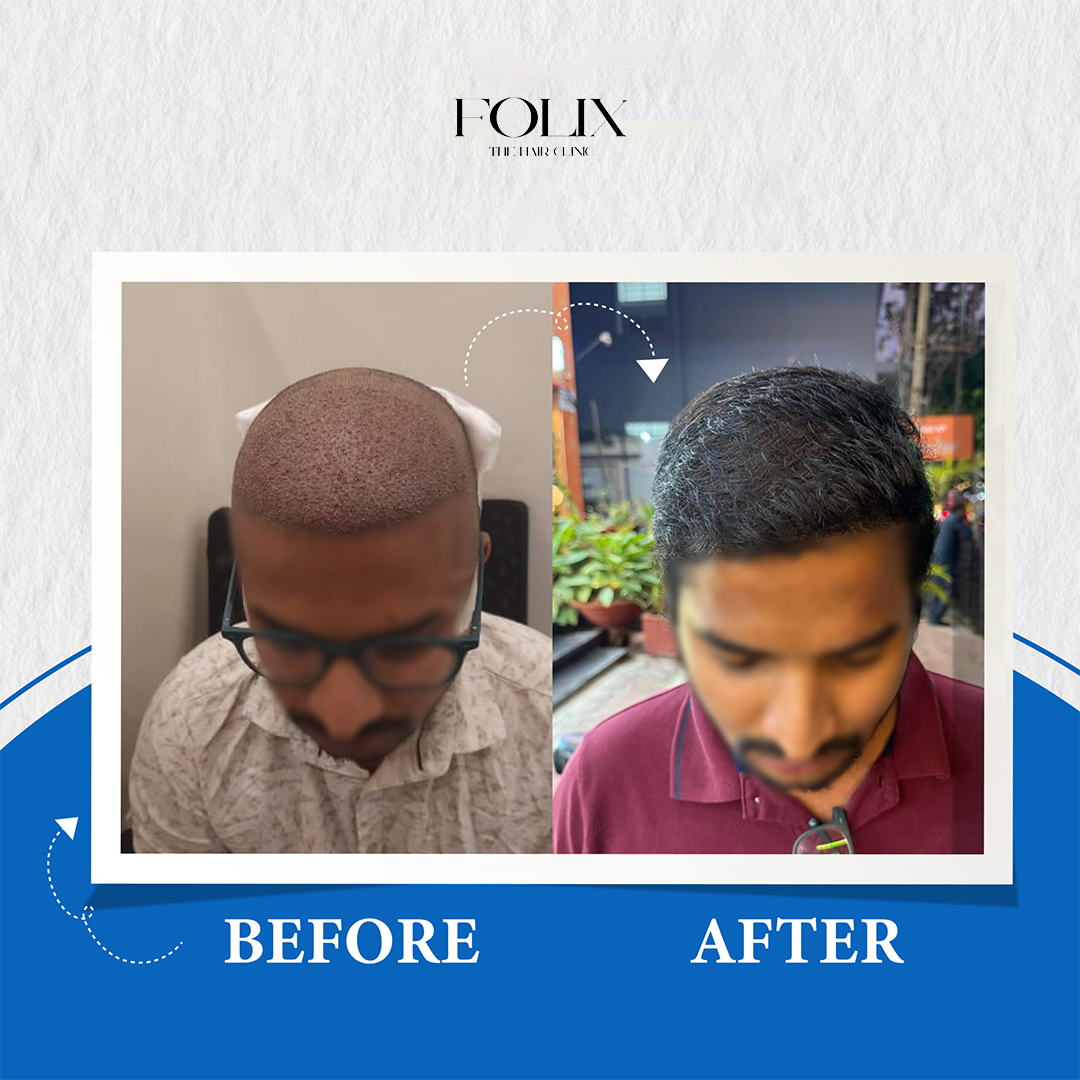 folix hair 1 copy 18