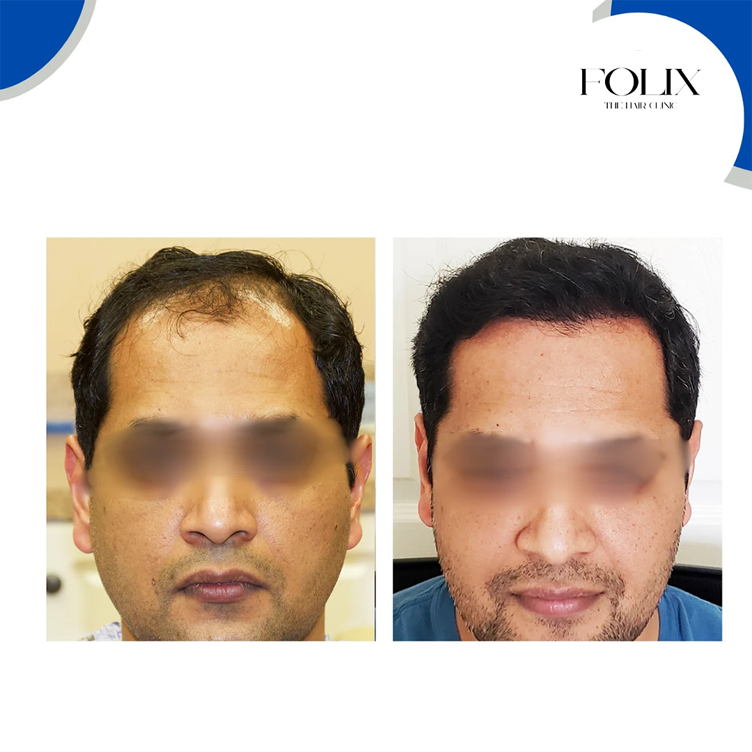 folix hair 1 copy 4