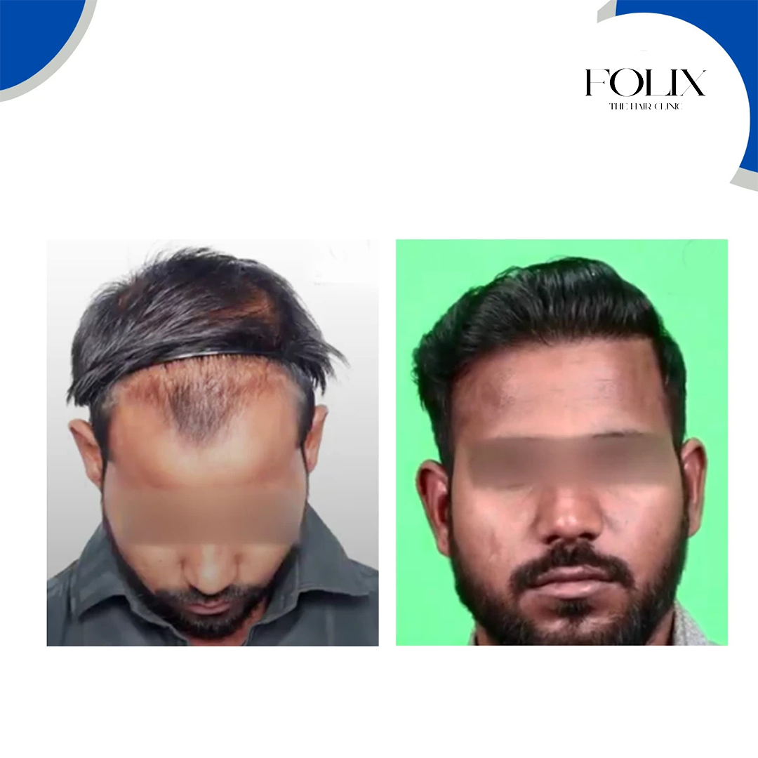 folix hair 1 copy 7