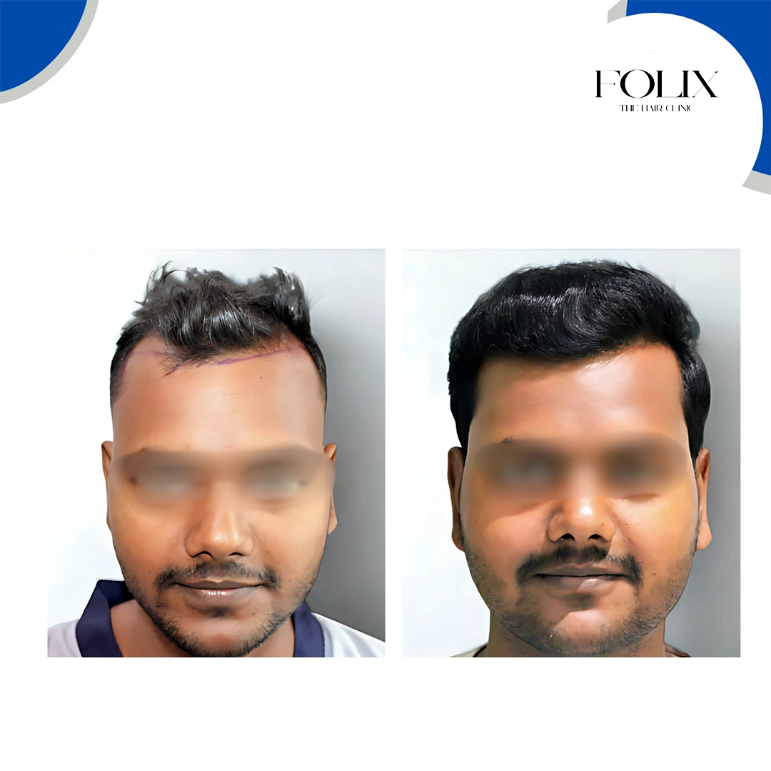 folix hair 1 copy 9