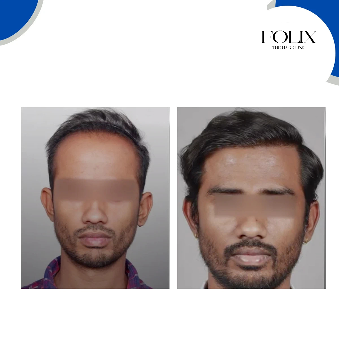 folix hair 1